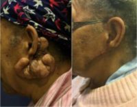 65-74 year old woman treated with Ear Surgery