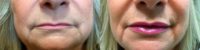 55-64 year old woman treated with Juvederm for Lip Augmentation