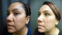 35-44 year old woman treated with Infini & LaseMD
