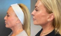 Woman treated with Nonsurgical Neck Lift