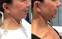 55-64 year old gender nonconforming person treated with Microneedling RF