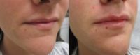 Juvederm Ultra to Nasolabial Folds & Lips