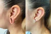 25-34 year old woman treated with Earlobe Repair