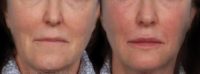 Woman treated with Dermal Fillers, Nonsurgical Facelift, Liquid Facelift