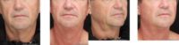 Evolastin Non-Surgical Face and Neck Lift with the ePrime radiofrequency device performed on a 50-year-old man.