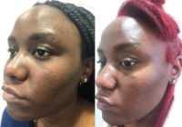 32 year old woman treated with Skin Rejuvenation
