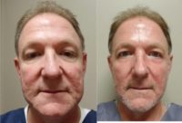 55-64 year old man treated with Non Surgical Face Lift