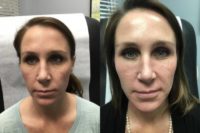25-34 year old woman treated with Fillers Under Eyes
