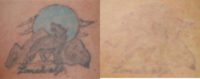 35-44 year old man treated with Tattoo Removal