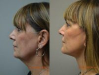 Woman treated with Facelift