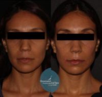 35-44 year old woman treated with Cheek Augmentation