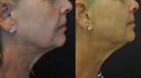 45-54 year old woman treated with Exilis