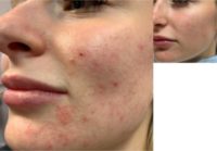 18-24 year old woman treated with Sylfirm X