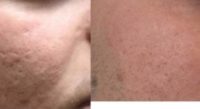 25-34 year old man treated with Microneedling