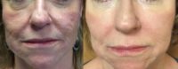 55-64 year old woman treated with Multiple PRPs and  Injectable Fillers