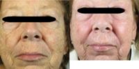 65-74 year old woman treated with Fraxel Laser