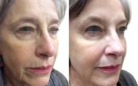 Patient treated with Sculptra Aesthetic by Dr. Carolyn Jacob