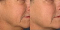 Woman treated with PicoSure