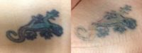 Blue Lizard Tattoo Before and After two Picosure treatments