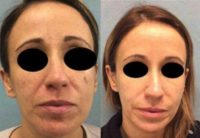 Woman treated with Age Spots Treatment