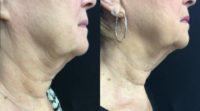 65-74 year old woman treated with Exilis