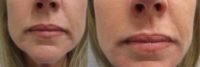 Juvederm Ultra XC to address downturned mouth & jowling
