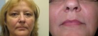 Treatment of Lips and Facial Lines