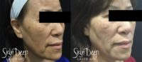 52 year old Asian woman after 2 treatments with PicoSure FOCUS