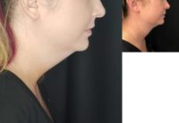 35-44 year old woman treated with CoolSculpting - Chin