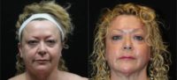 55-64 year old woman treated with for skin tightening with J-Plasma