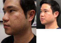 35-44 year old man treated with Vampire Facelift