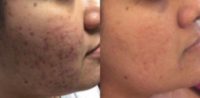 25-34 year old woman treated with SkinPen
