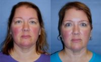 Neck treated with CoolSculpting