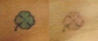 Four Leaf Clover - Tattoo Removal
