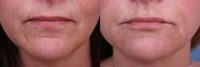 Evolence Collagen for Marionette Lines and Chin