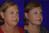 Female treated with Facelift