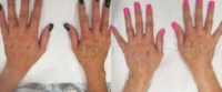 Woman treated with Age Spots Treatment
