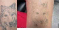 NONCOMP 35-44 year old man treated with Tattoo Removal