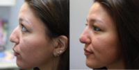 Non-Surgical Nose Job with Dermal Filler