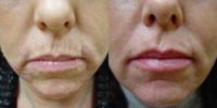 Radiesse and Restylane to Nasolabial Folds, Marionettes and Lips