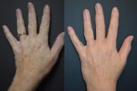 Single treatment using Cutera's Pico Genesis laser to treat brown spots on hands