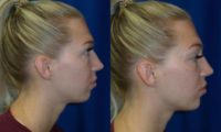 18-24 year old woman treated with Chin Filler