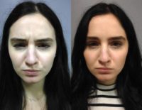 24 year old woman treated with Botox