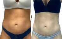 25-34 year old woman treated with Emsculpt