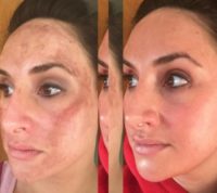 25-34 year old woman treated with Chemical Peel for melasma