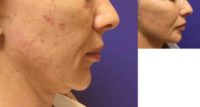 28 Year Old Miss Treated With Non Surgical Face Lift Candidate With Doctor Greenspring Rejuvenation Medical Aesthetics - Tucson