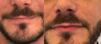 25-34 year old man treated with Lip Augmentation
