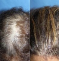 25-34 year old woman treated with PRP for Hair Loss