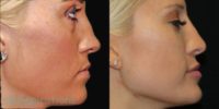 25-34 year old woman treated with Nonsurgical Nose Job