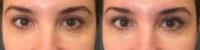 25-34 year old woman treated with a Lash Lift